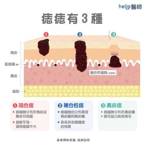 算命長毛的痣|痣凸起長毛？專家解答